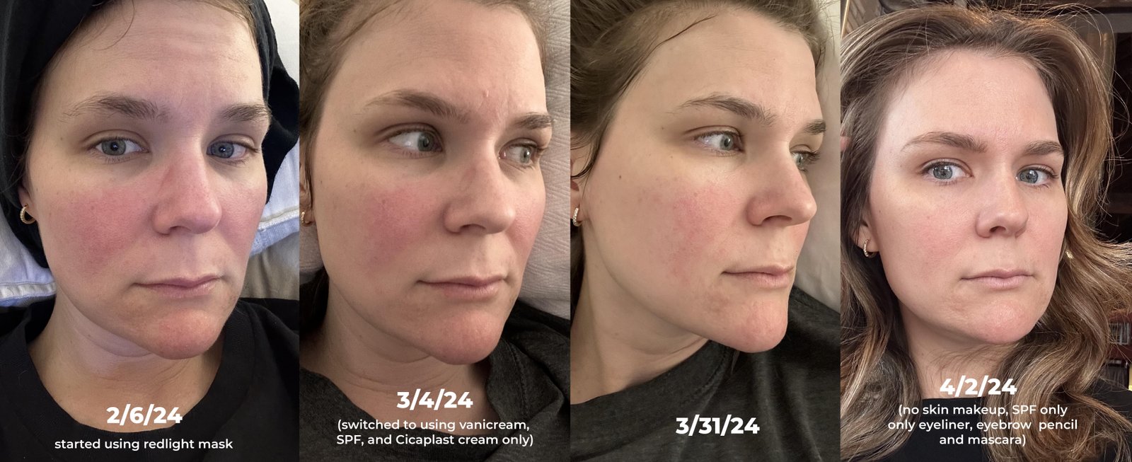 Before and after red light therapy results showing skin improvement over 2 months